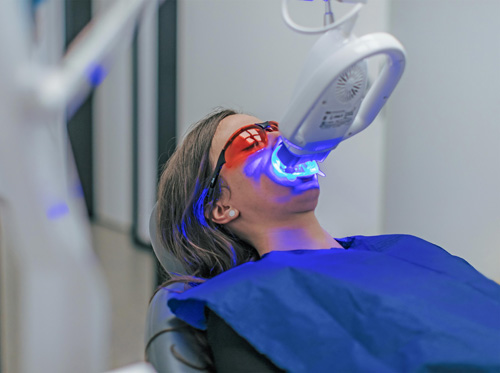 lasersko izbeljivanje zuba akcija