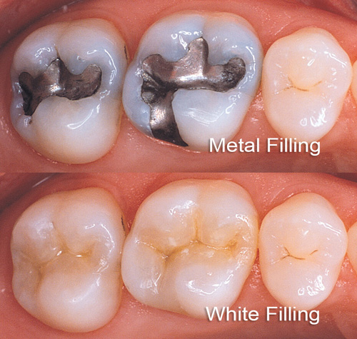Popravljanje zuba