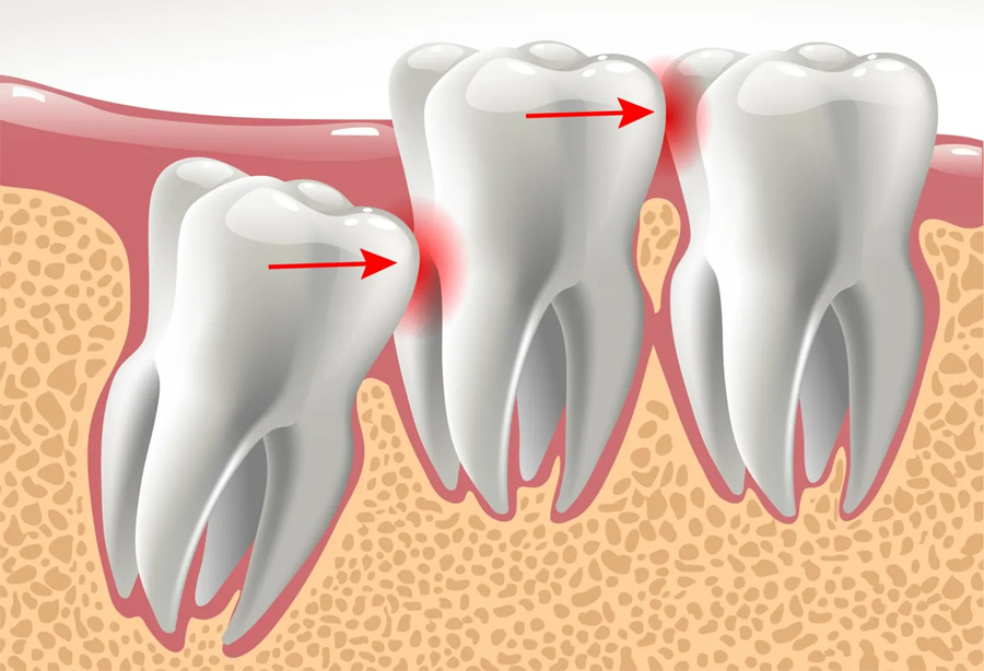 vadjenje impaktiranih zuba